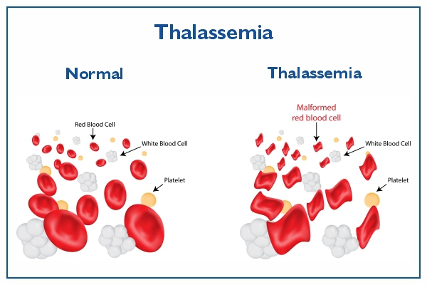 Understanding Thalassemia